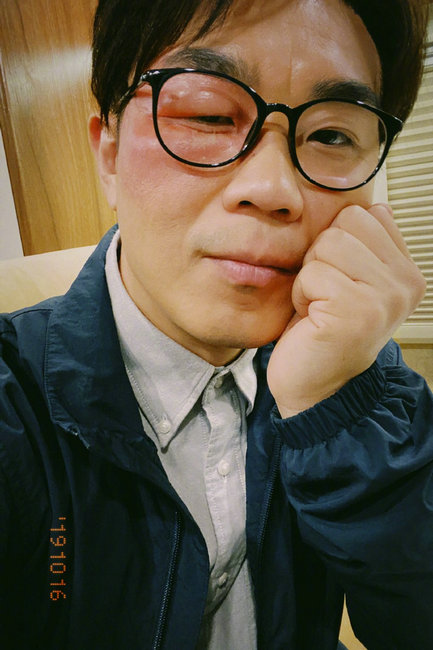 大鹏深夜晒照张脸肿的吓人 心疼之余有点想笑