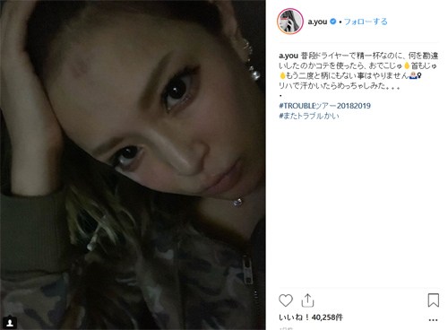 滨崎步ins晒额头烧伤照 粉丝大呼心疼